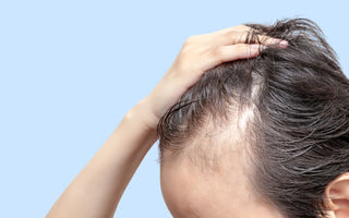 Lo que tienes que saber sobre "Alopecia"